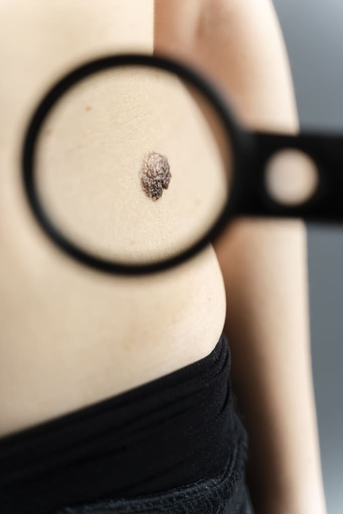 close-up-magnifying-glass-mole