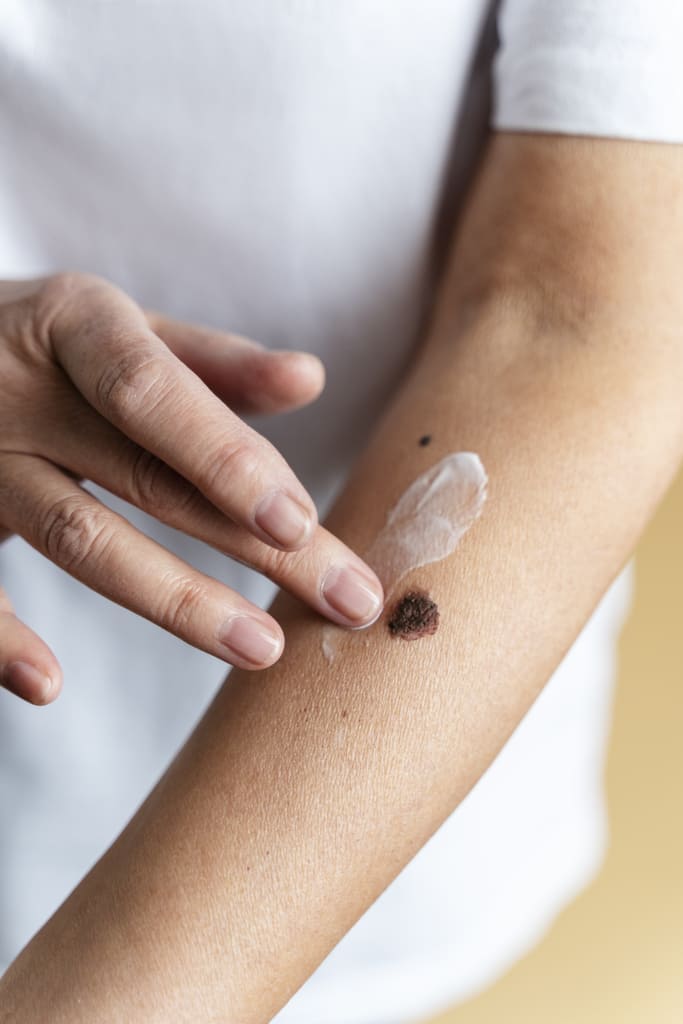 high-angle-hand-applying-cream-arm