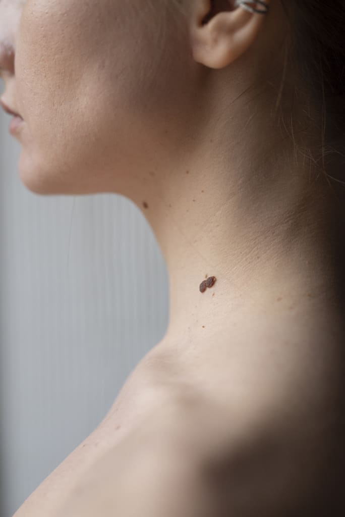 woman-with-melanoma-her-skin